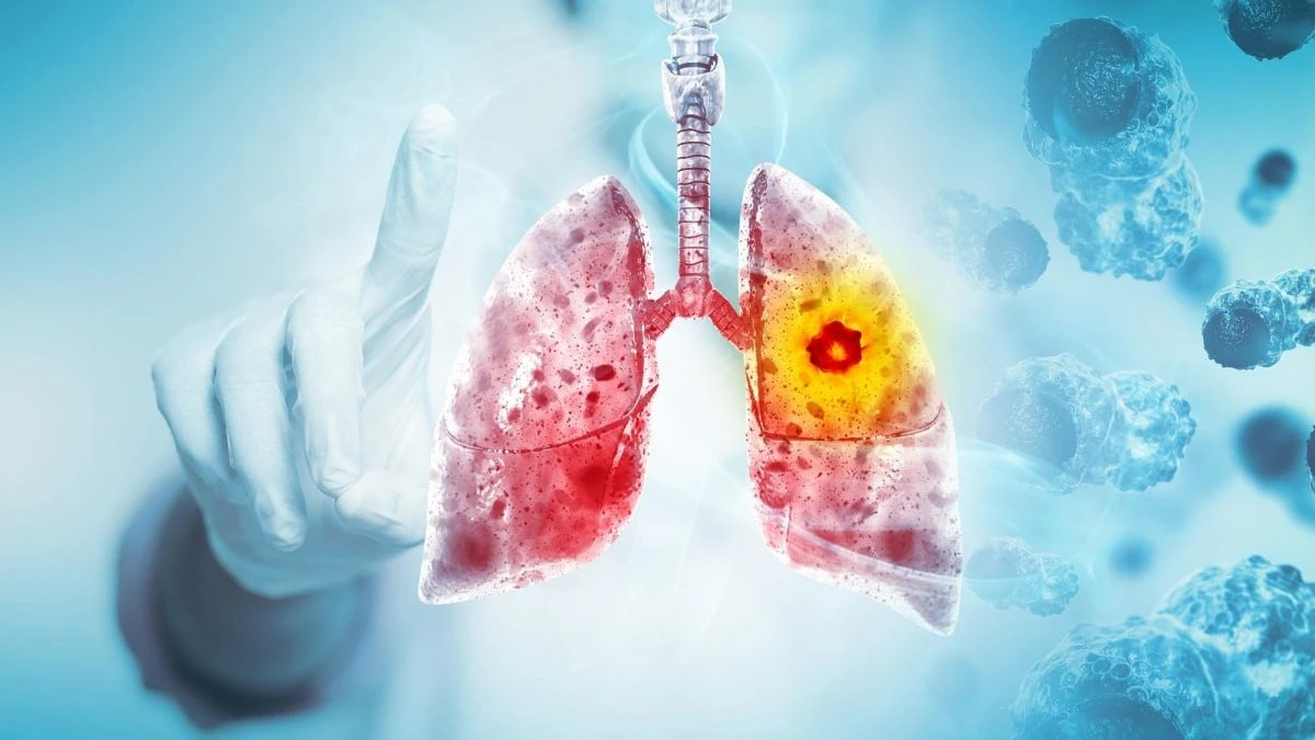 Akciğer kanserinde bağışıklıktan kaçan gizli fibroblastlar bulundu