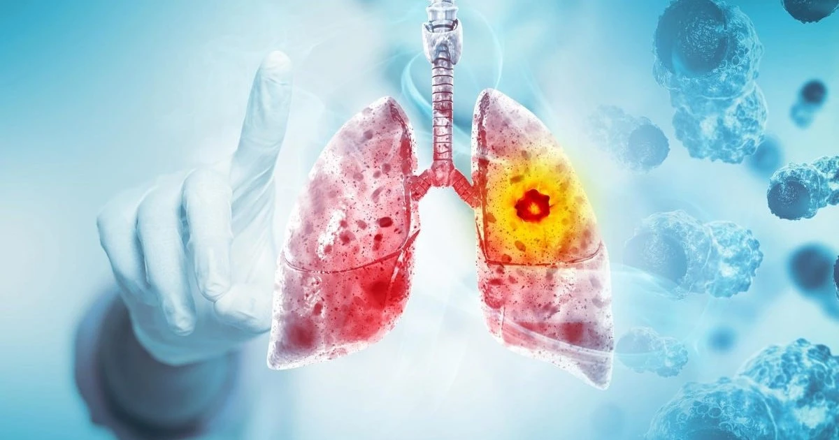 Akciğer kanserinde bağışıklıktan kaçan gizli fibroblastlar bulundu