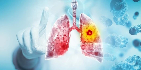 Akciğer kanserinde bağışıklıktan kaçan gizli fibroblastlar bulundu